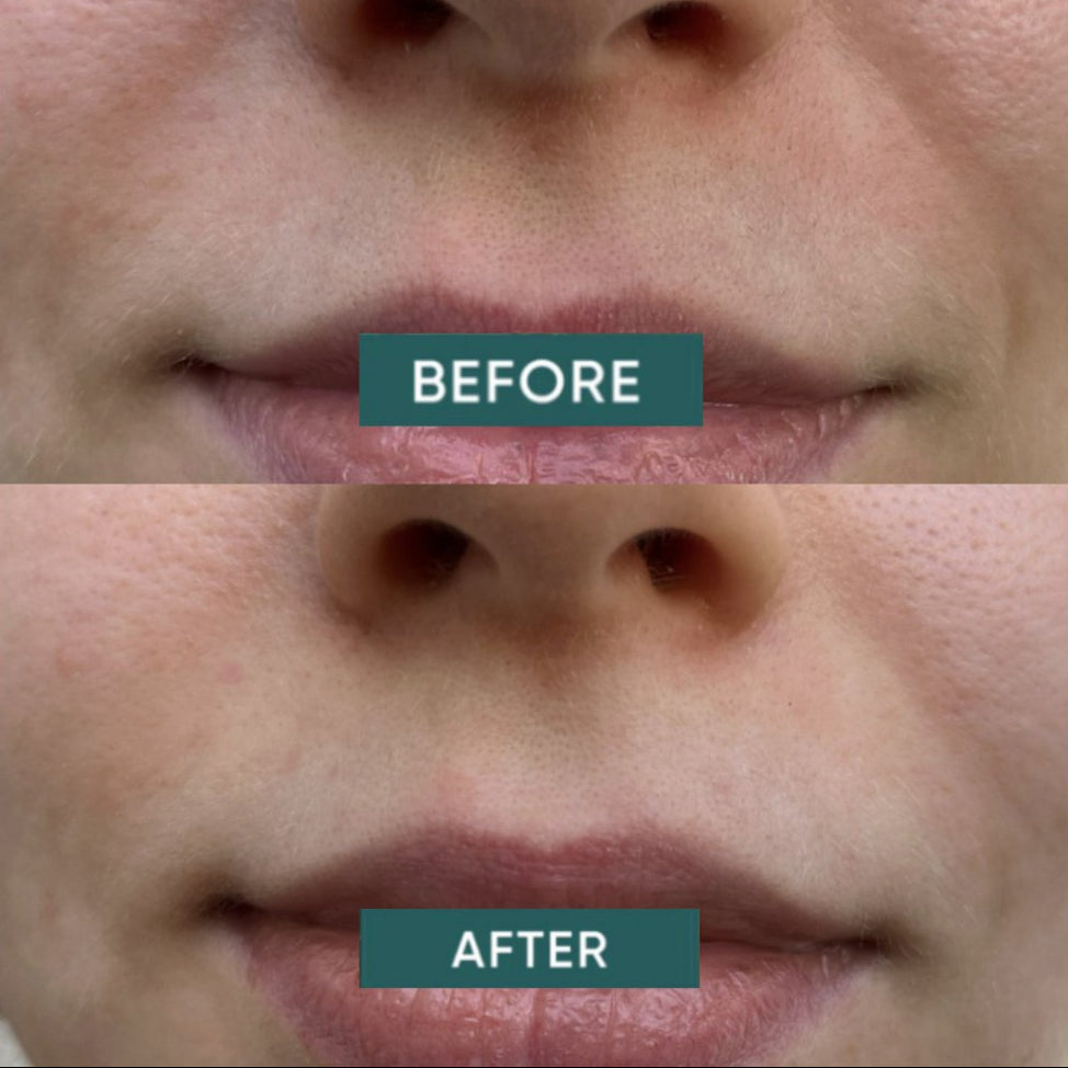 Apricot Hyaluron Mouth Patches – plaster til området omkring munden, der tilfører intensiv fugt og reducerer fine linjer