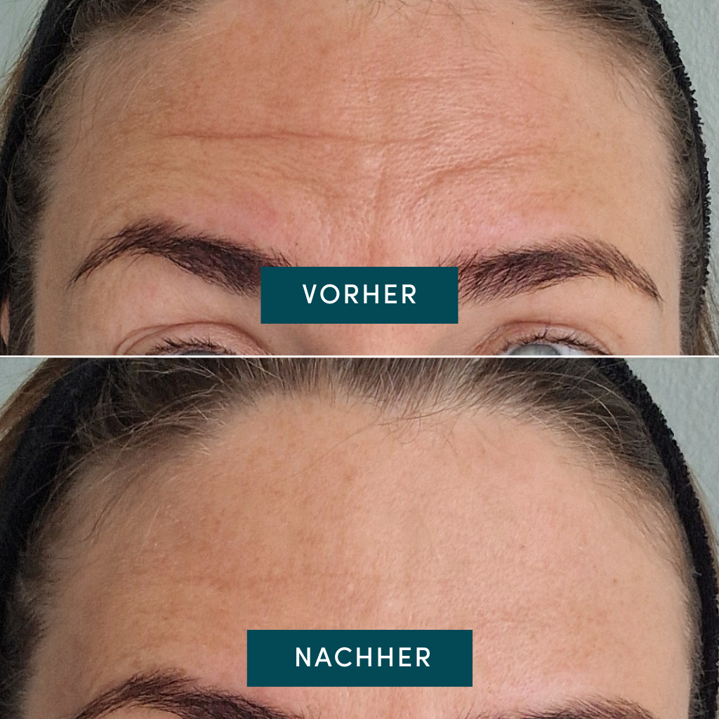 Apricot C-vitamin Forehead Pads – genanvendelig maske til panden, der reducerer linjer og giver huden glød og fasthed
