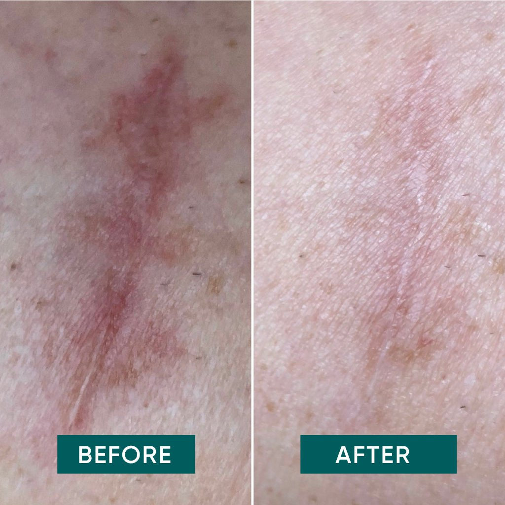 Ar- &amp; silikoneplaster med aloe vera - genanvendelige til nye og gamle ar