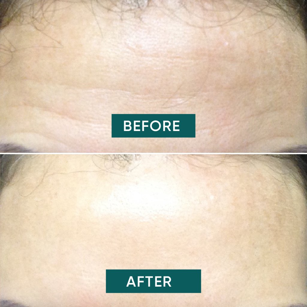 Apricot Hyaluron Forehead Pad – genanvendelig maske til panden, der giver intensiv fugt, reducerer linjer og efterlader huden glat og frisk