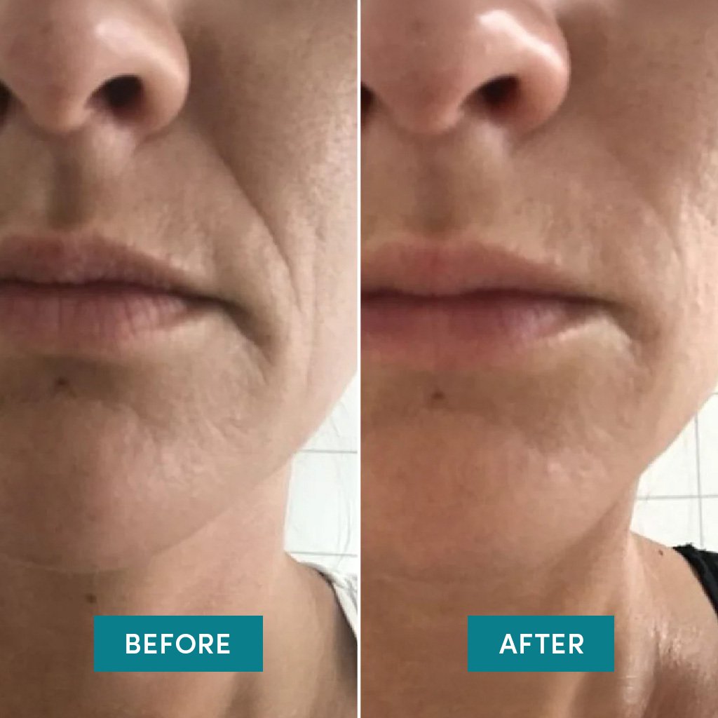 Silikonemasker med Hyaluron | Genanvendelige Pads